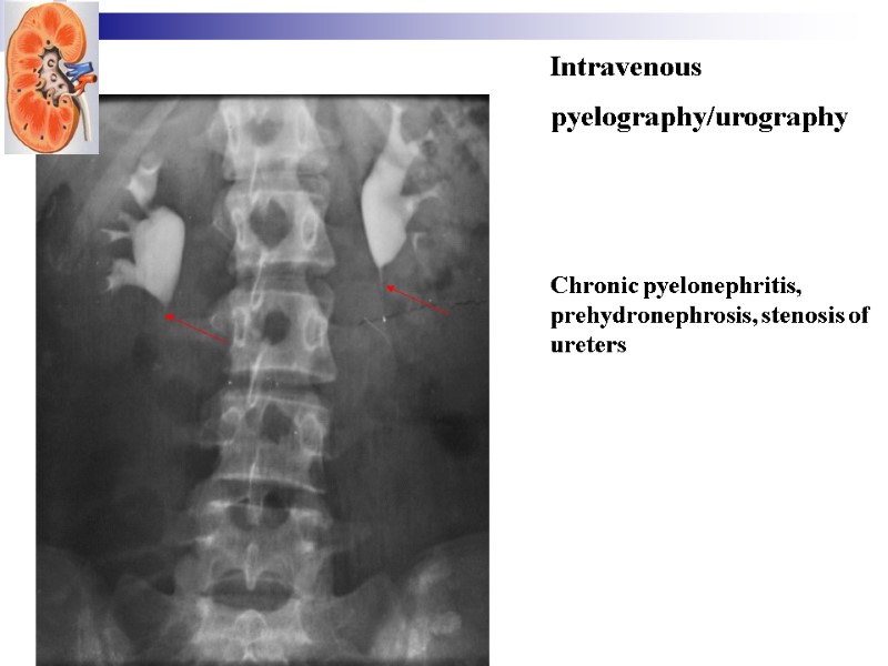 Intravenous pyelography/urography    Chronic pyelonephritis, prehydronephrosis, stenosis of ureters